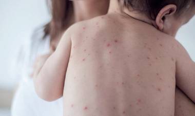 El ministerio de Salud emitió un alerta epidemiológica por nuevos casos de sarampión